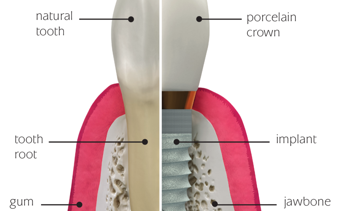 Dental Implants